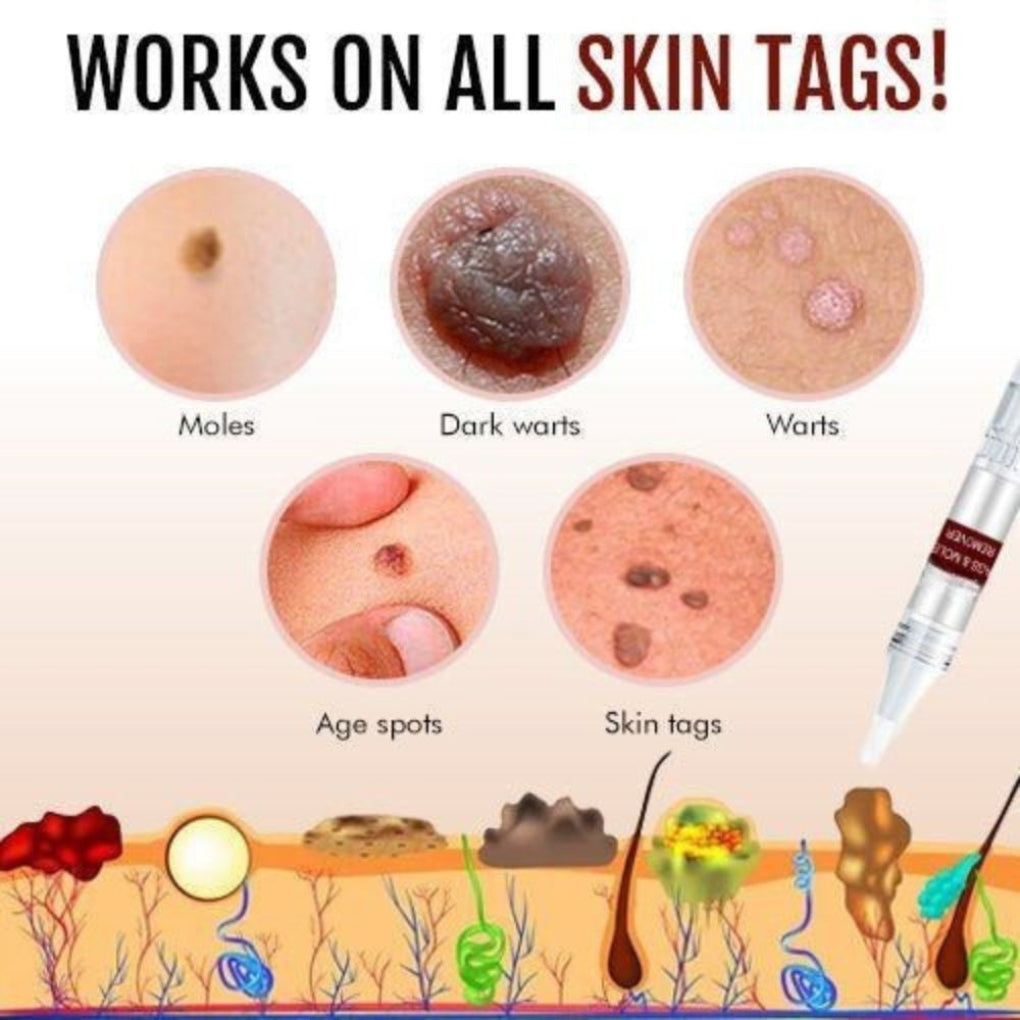 Tea Tree Oil natural skin tag and mole remover pen for effective blemish removal & clear, healthy skin.