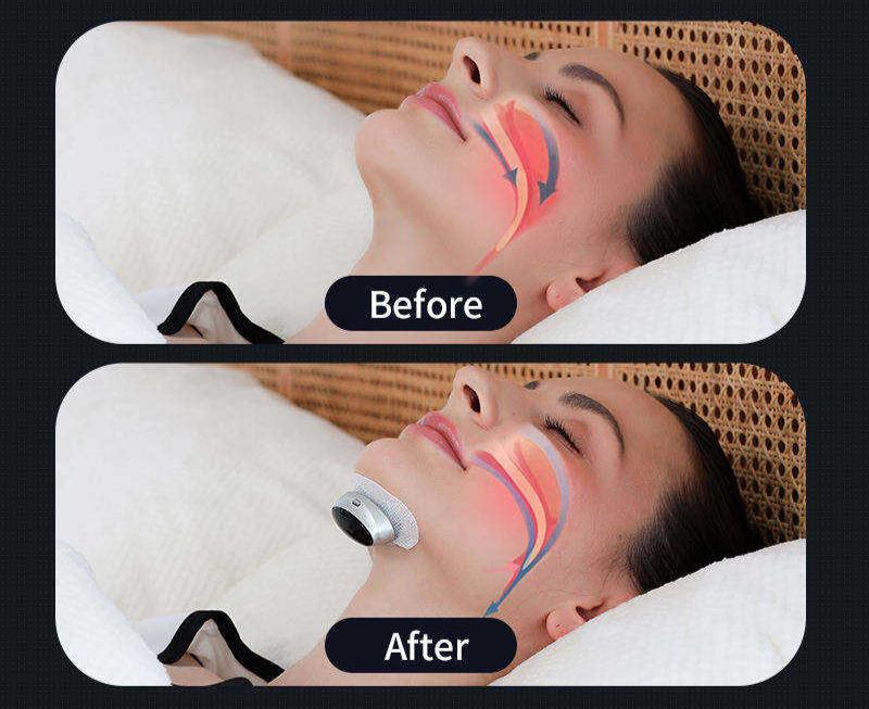 Compact AirEase anti-snoring device for sleep apnea, ensuring comfortable and portable breathing support.