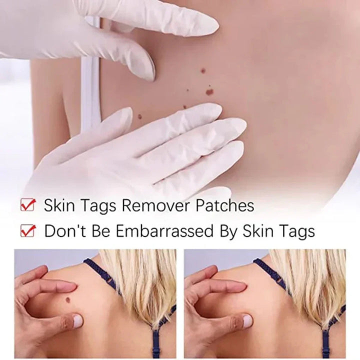 Gentle natural skin tag & mole remover pen. Achieve clear, smooth skin with this easy-to-use beauty tool.