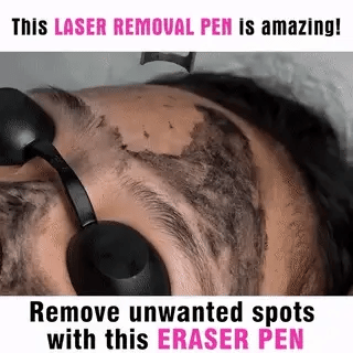 Compact beauty device: portable laser pen for at-home tattoo, mole & freckle removal.